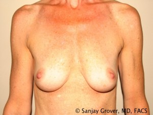 Breast Augmentation Before and After 53 | Sanjay Grover MD FACS