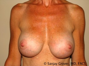 Breast Augmentation Before and After | Grover Aesthetics