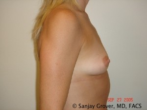 Breast Augmentation Before and After 156 | Sanjay Grover MD FACS