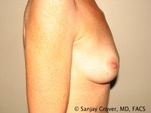 Breast Augmentation Before and After 156 | Grover Aesthetics