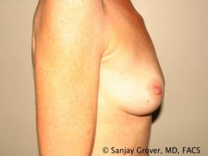 Breast Augmentation Before and After 156 | Sanjay Grover MD FACS