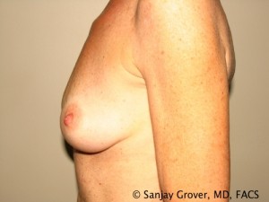 Breast Augmentation Before and After 156 | Grover Aesthetics