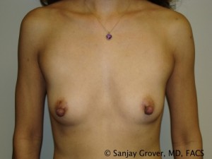 Breast Augmentation Before and After 42 | Sanjay Grover MD FACS