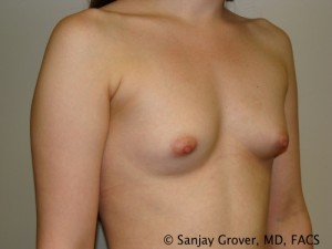 Breast Augmentation Before and After 157 | Sanjay Grover MD FACS