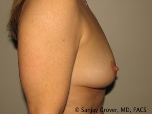 Breast Augmentation Before and After 158 | Grover Aesthetics