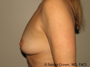Breast Augmentation Before and After 158 | Grover Aesthetics