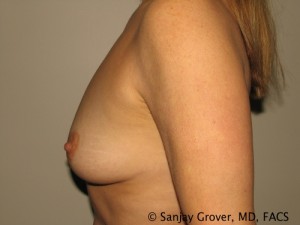 Breast Augmentation Before and After 158 | Sanjay Grover MD FACS