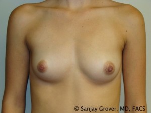 Breast Augmentation Before and After 64 | Sanjay Grover MD FACS