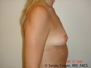 Breast Augmentation Before and After 159 | Grover Aesthetics