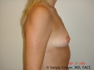 Breast Augmentation Before and After 159 | Sanjay Grover MD FACS