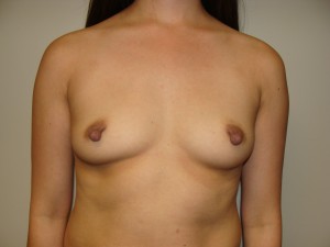 Breast Augmentation Before and After 313 | Sanjay Grover MD FACS