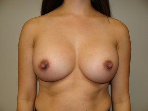 Breast Augmentation Before and After | Grover Aesthetics