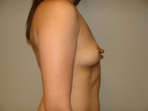 Breast Augmentation Before and After 16 | Grover Aesthetics