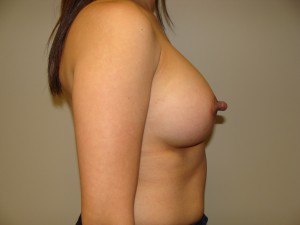 Breast Augmentation Before and After 16 | Grover Aesthetics