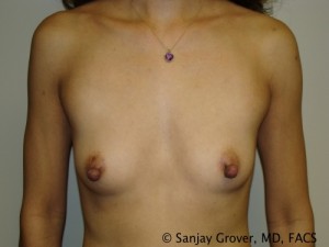 Breast Augmentation Before and After 312 | Sanjay Grover MD FACS