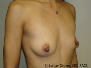 Breast Augmentation Before and After 160 | Sanjay Grover MD FACS