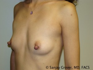 Breast Augmentation Before and After 160 | Sanjay Grover MD FACS