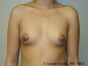 Breast Augmentation Before and After | Grover Aesthetics