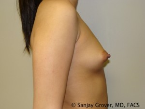 Breast Augmentation Before and After 161 | Grover Aesthetics