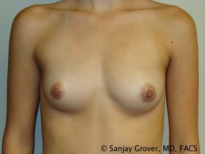 Breast Augmentation Before and After 204 | Sanjay Grover MD FACS