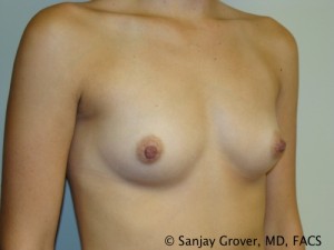 Breast Augmentation Before and After 162 | Grover Aesthetics