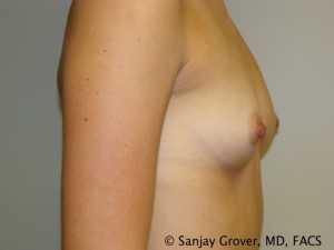 Breast Augmentation Before and After 162 | Grover Aesthetics