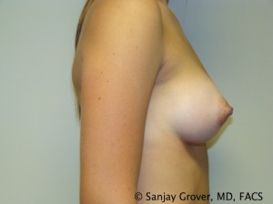 Breast Augmentation Before and After 162 | Grover Aesthetics