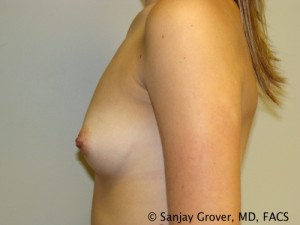 Breast Augmentation Before and After 162 | Grover Aesthetics