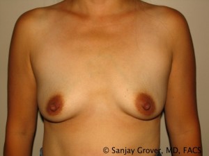 Breast Augmentation Before and After 283 | Sanjay Grover MD FACS