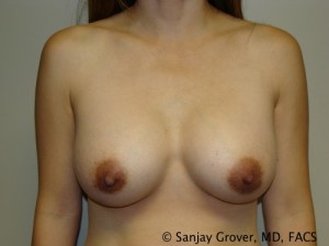 Breast Augmentation Before and After | Grover Aesthetics