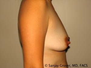 Breast Augmentation Before and After 163 | Grover Aesthetics