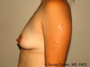 Breast Augmentation Before and After 163 | Grover Aesthetics