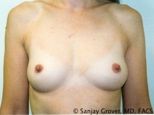 Breast Augmentation Before and After 11 | Sanjay Grover MD FACS