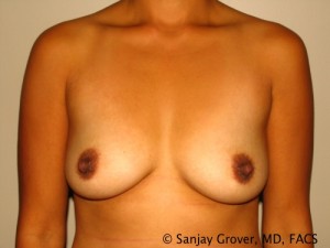 Breast Augmentation Before and After | Grover Aesthetics