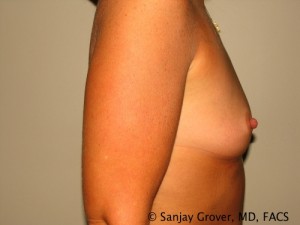 Breast Augmentation Before and After 165 | Grover Aesthetics