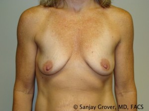 Breast Augmentation Before and After 37 | Sanjay Grover MD FACS