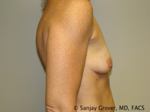 Breast Augmentation Before and After 166 | Grover Aesthetics