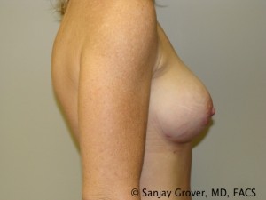 Breast Augmentation Before and After 166 | Grover Aesthetics