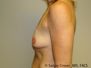 Breast Augmentation Before and After 166 | Grover Aesthetics