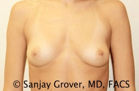 Breast Augmentation Before and After 88 | Sanjay Grover MD FACS