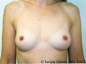 Breast Augmentation Before and After 204 | Sanjay Grover MD FACS