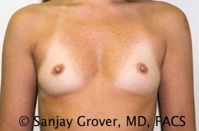 Breast Augmentation Before and After 235 | Sanjay Grover MD FACS
