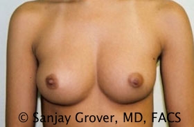 Breast Augmentation Before and After | Grover Aesthetics