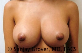 Breast Augmentation Before and After | Grover Aesthetics