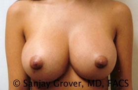 Breast Augmentation Before and After | Sanjay Grover MD FACS