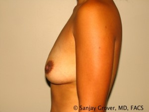 Breast Augmentation Before and After 168 | Grover Aesthetics