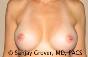 Breast Augmentation Before and After | Grover Aesthetics