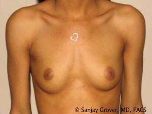 Breast Augmentation Before and After 18 | Sanjay Grover MD FACS