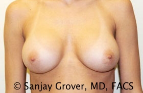 Breast Augmentation Before and After | Grover Aesthetics