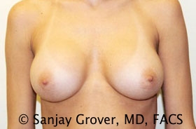 Breast Augmentation Before and After | Sanjay Grover MD FACS